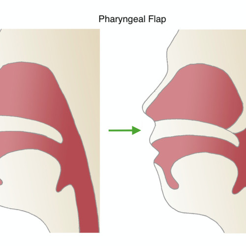 Pharyngeal Flap