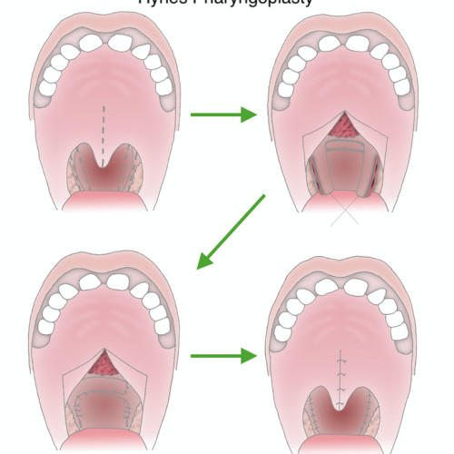 Hynes Pharyngoplasty