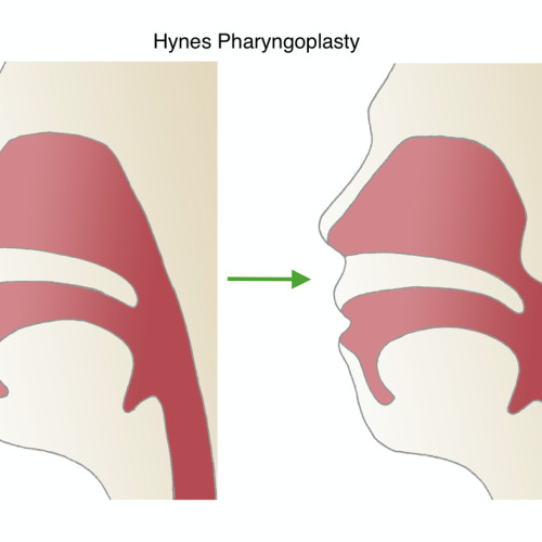Hynes Pharyngoplasty